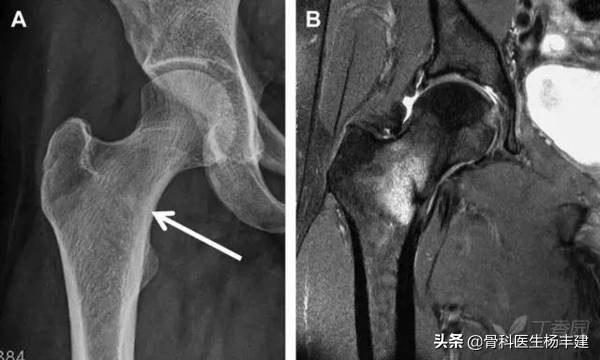 专家级科普，老年人的骨折与年轻人有哪些不一样？