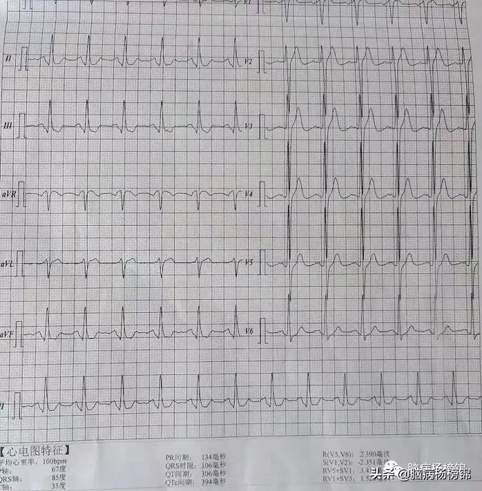 流感病毒引起的心肌梗塞,这几天的流感是怎么回事