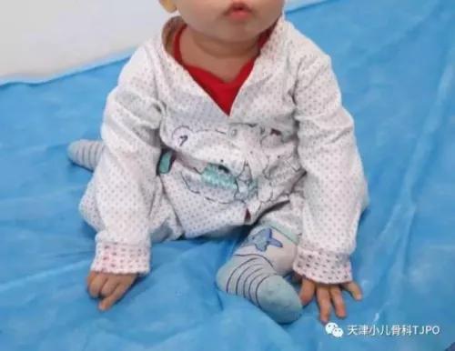 8岁孩子足外翻有必要治吗,骨科医生谈幼儿脚内扣