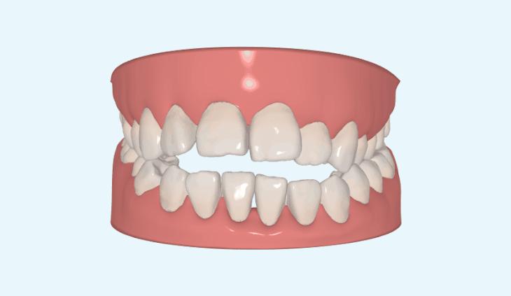 正畸矫正知识,正畸知识科普视频