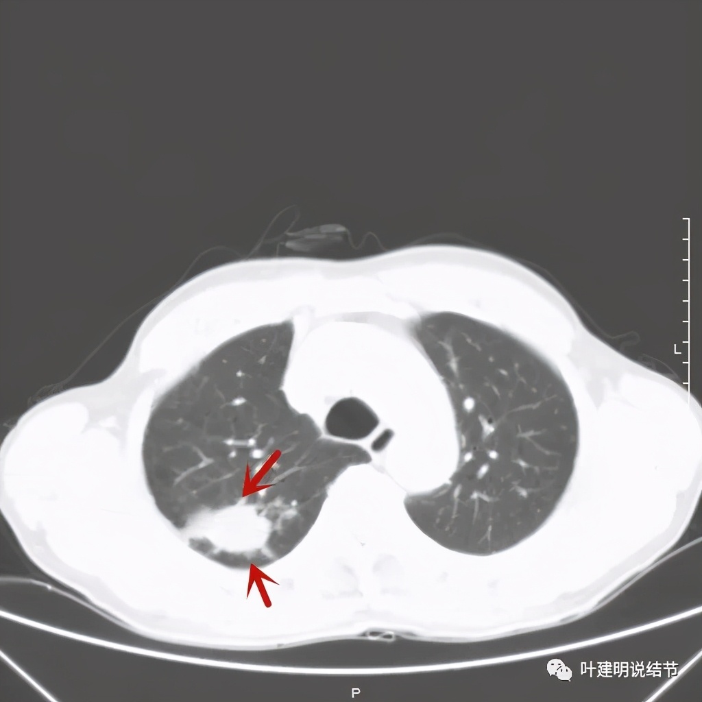 肺占位病理活检无病变,肺部占位穿刺病理说不确定性质