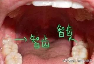 「科普」还在纠结是否拔智齿？看完你就明白了