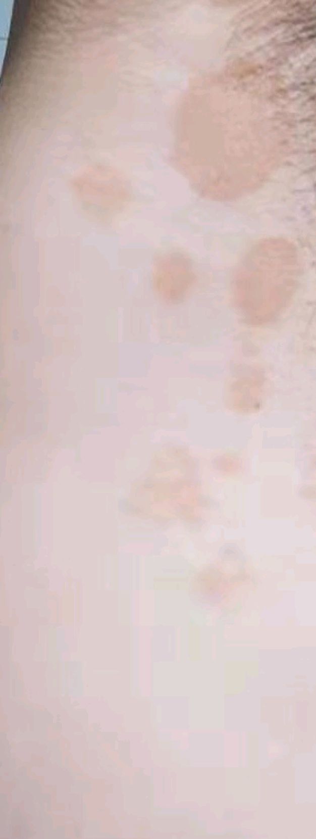 汗斑怎么去除才能彻底根治,背上有汗斑怎么样才能根治