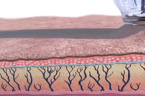 痘印反复冒痘怎么消除男生,痘印痘痘反反复复怎么办