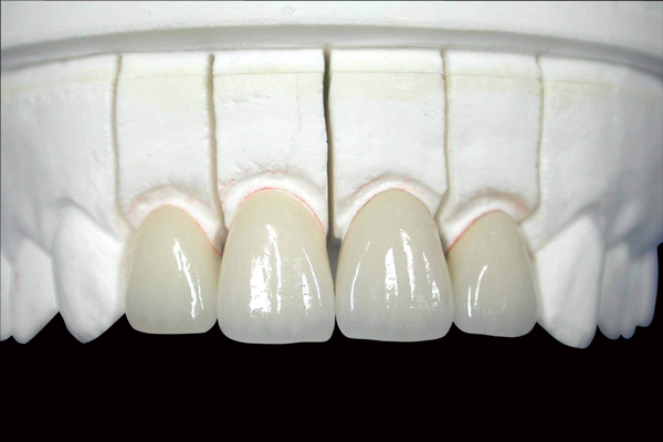 刘涛花了多少钱做牙齿,刘涛整牙花了多少钱