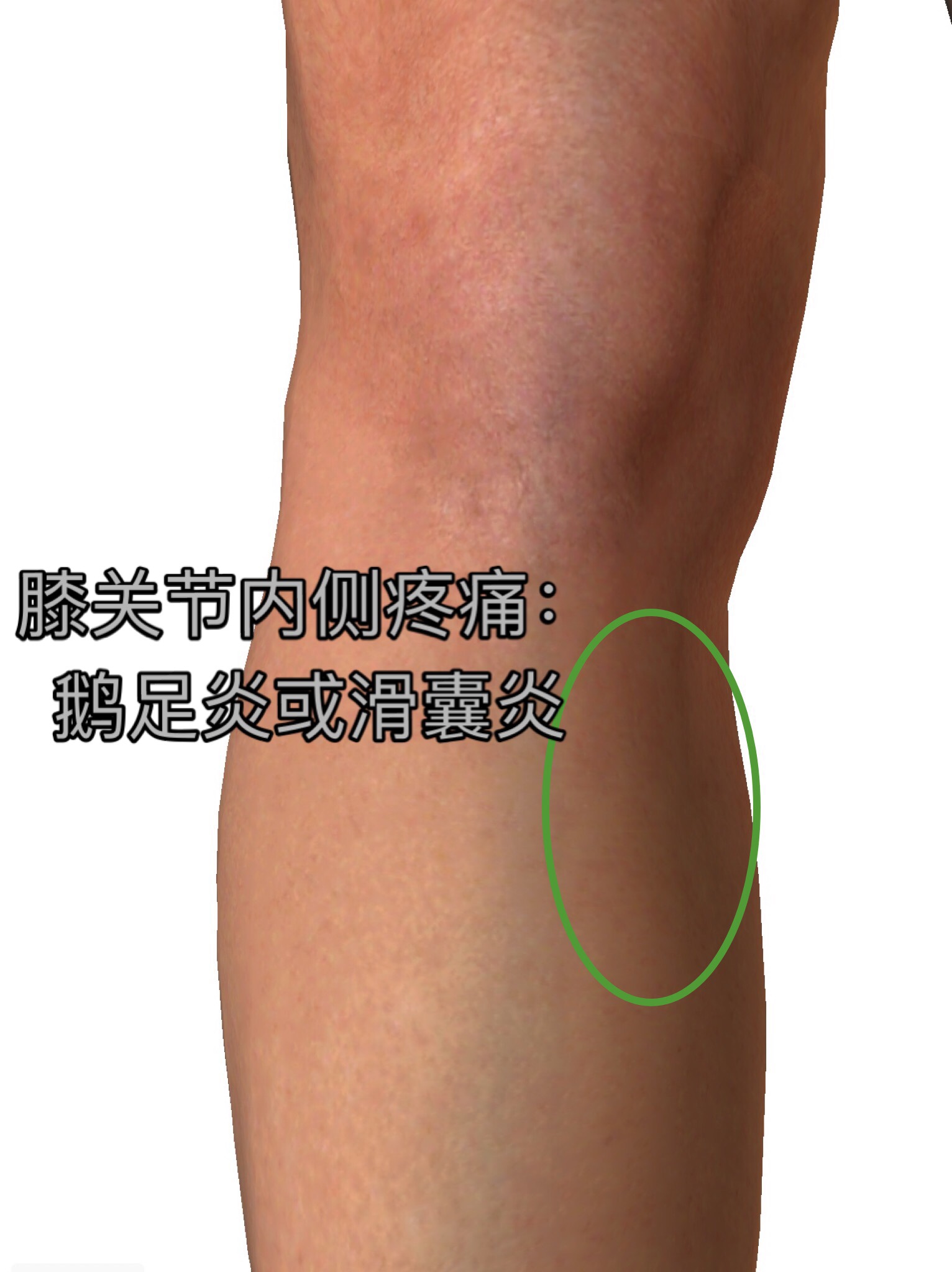 膝盖内侧鹅足腱肿了怎么治疗,腿部鹅足腱疼怎么解决