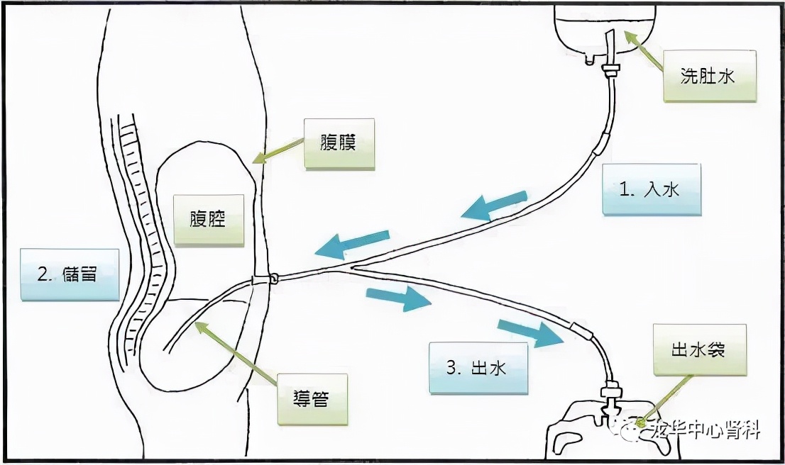 名医专访｜栾韶东：腹膜透析——自己在家做的透析