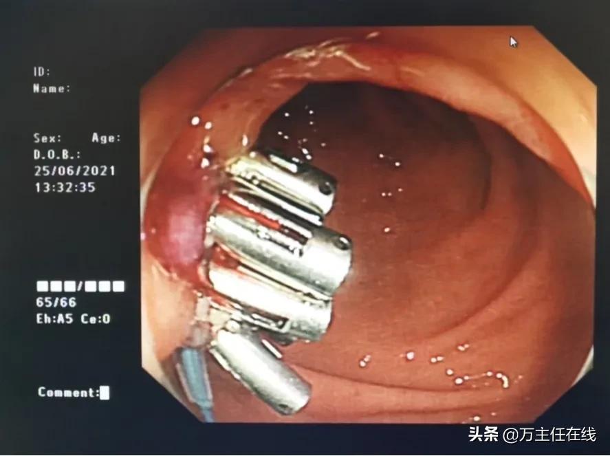 镜益求精！上海市第一人民医院万荣团队为患者带来“无痕”的美丽