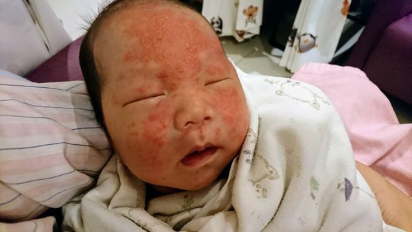 脂溢性皮炎脸部护理,脂溢性皮炎最简单自愈方法婴儿