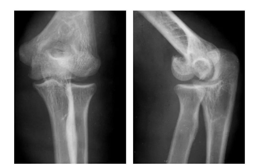 青少年肘部损伤最常见的是,肘部桡神经损伤的临床表现
