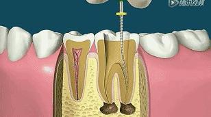 根管治疗第四步骤,根管治疗案例分享话术