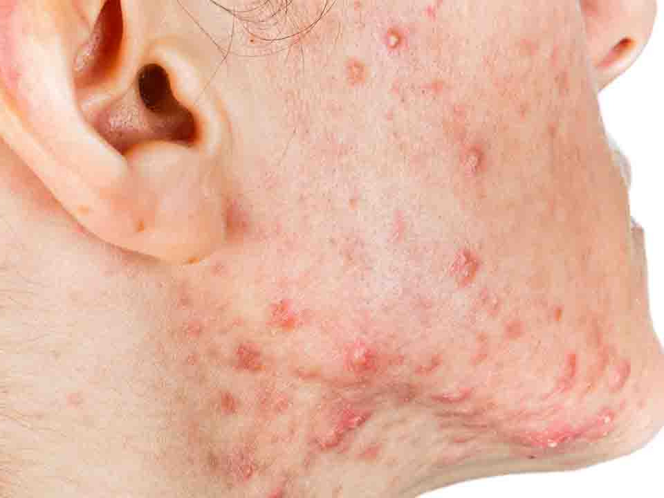 长疮怎么处理表面,长了疮怎么办