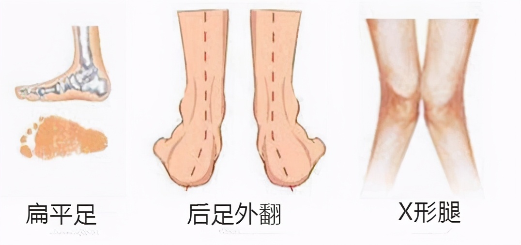 产后如何瘦脚最有效,生完宝宝胯宽怎么锻炼变窄