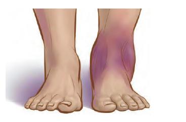 又崴脚了,刚崴到脚了怎么及时处理