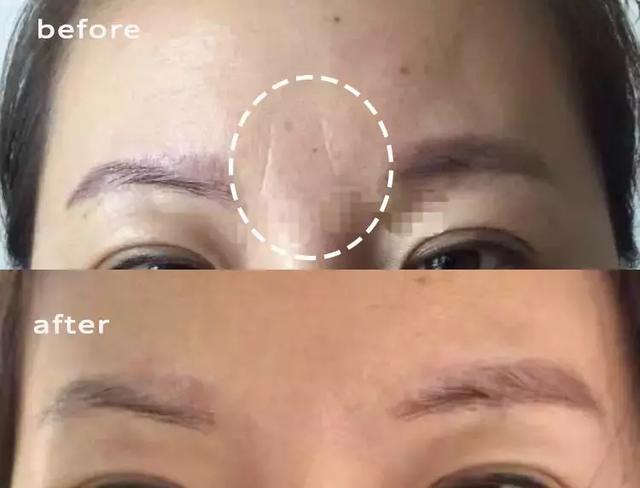 硬刚女皇龙妈也扛不住法令纹,2条沟壑让人心疼,贴一贴就消了