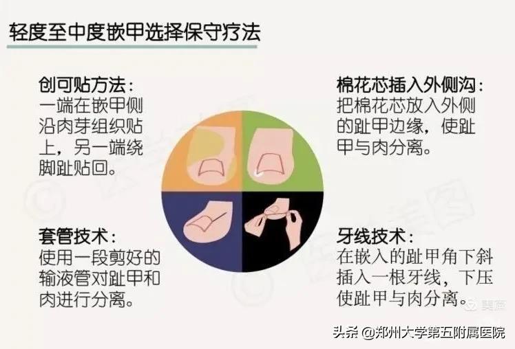 小孩怎么预防嵌甲,怎么预防嵌甲和甲沟炎