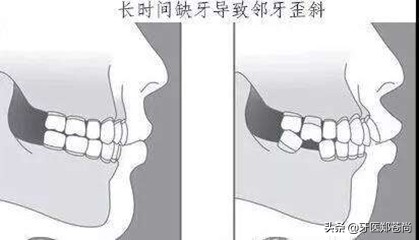 缺失牙修复视频教程,缺失牙修复固定桥