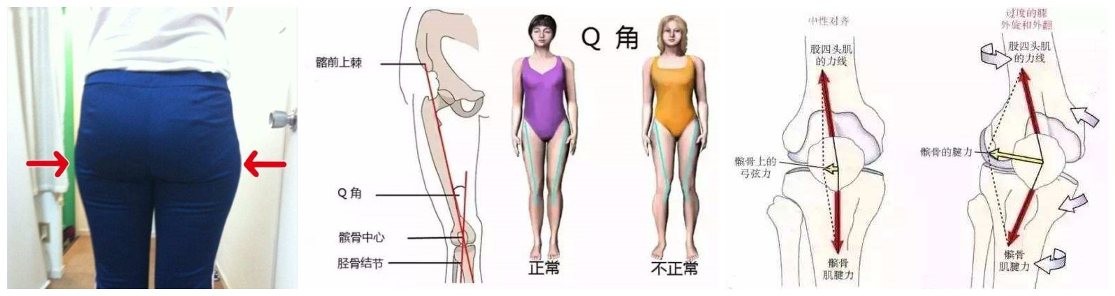 如何保护膝关节半月板,保护半月板的运动护具