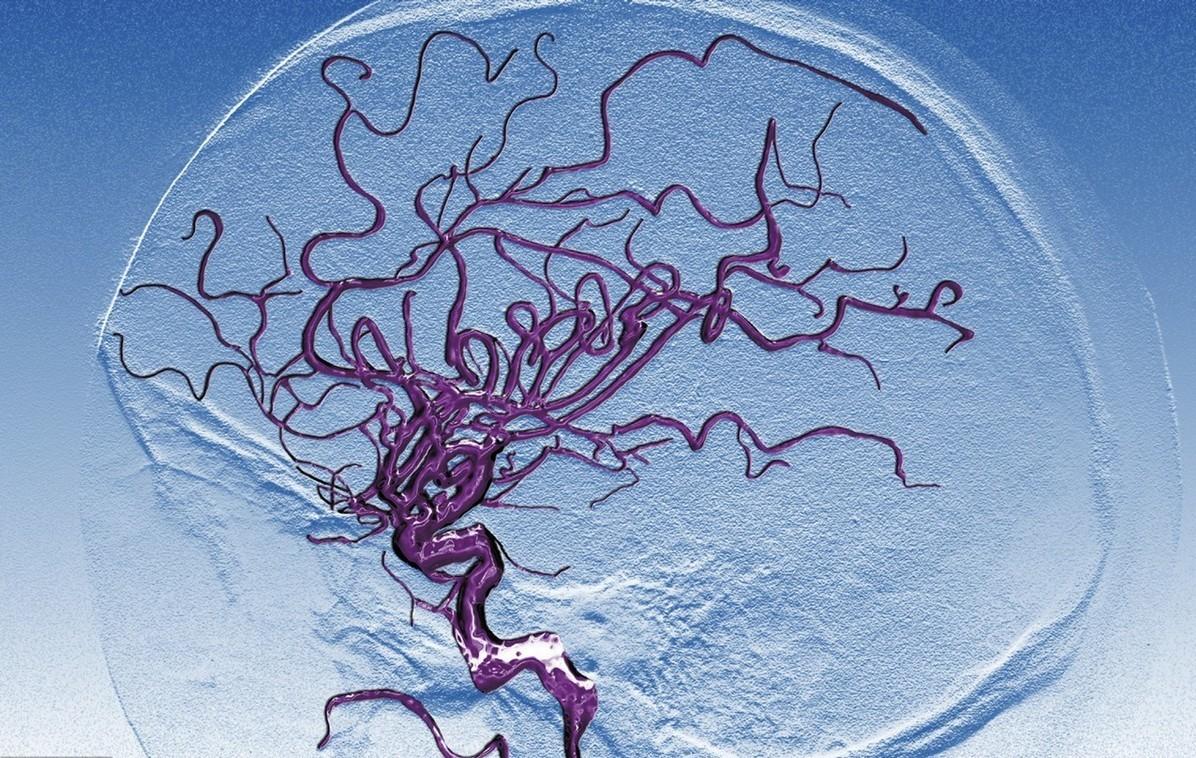 腔梗和腔隙性脑梗有什么区别,腔隙性的脑梗是什么原因造成的