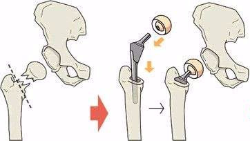 老年人肱骨骨折后该不该手术治疗,老人骨折的症状和治疗方法