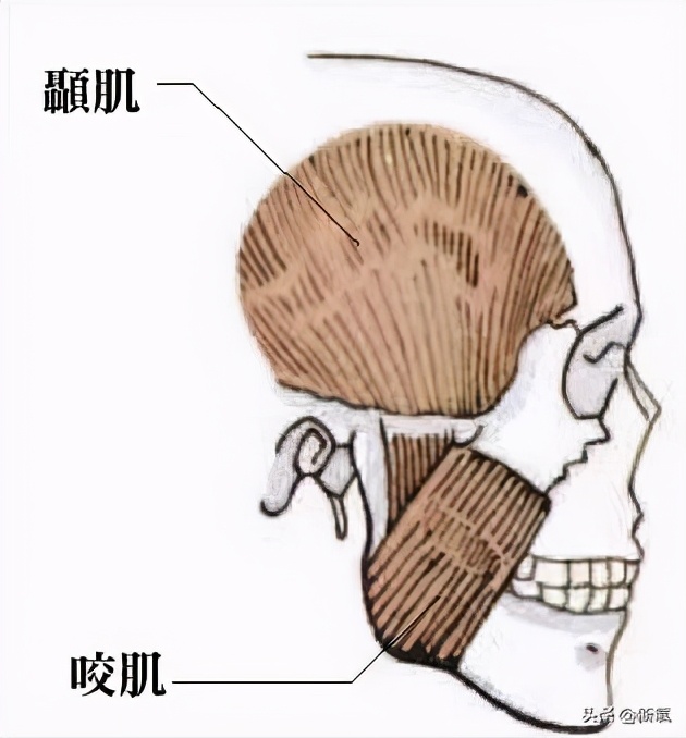 戴牙套真的会出现牙套脸,戴牙套期间牙齿变龅了