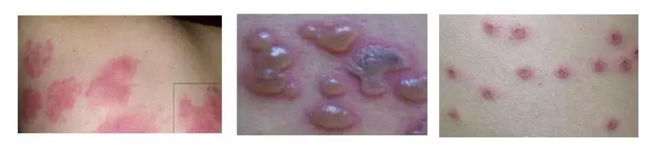 预防水痘高发温馨提示,现在哪个省进入水痘高发期