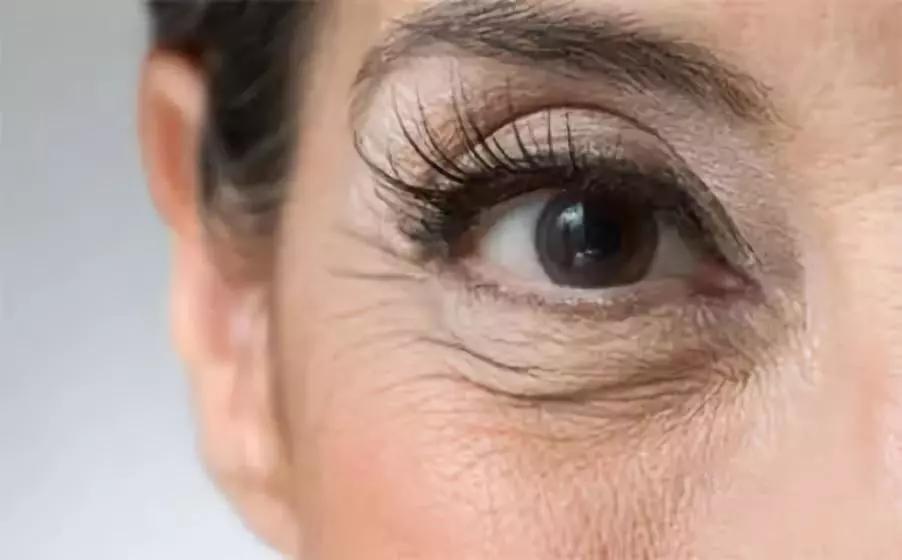 别再用针挑！用米澳拉，脂肪粒自己“掉”下来，效果胜过医美激光