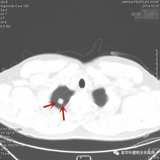 叶建明谈胸膜下的实性结节,叶建明肺实性良性结节会变癌症吗