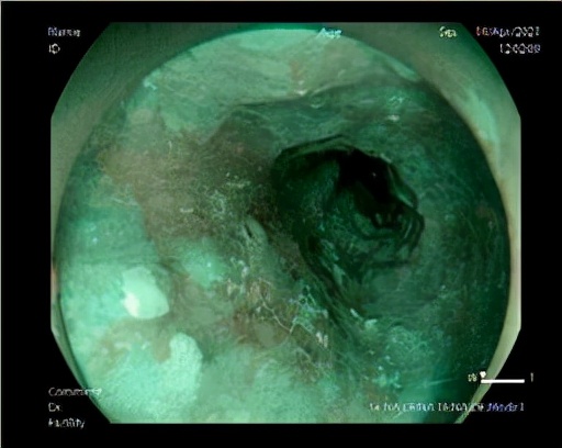 容易忽视的症状有哪些,最容易忽视的三种癌