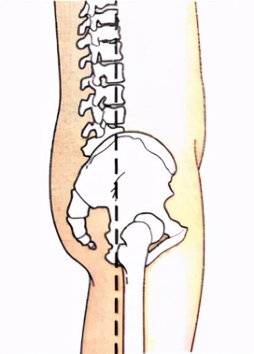 腰变直要怎样矫正,能让腰变直的几个动作