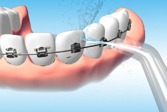 门牙一颗牙有缝怎样补,门牙有缝多大可以补