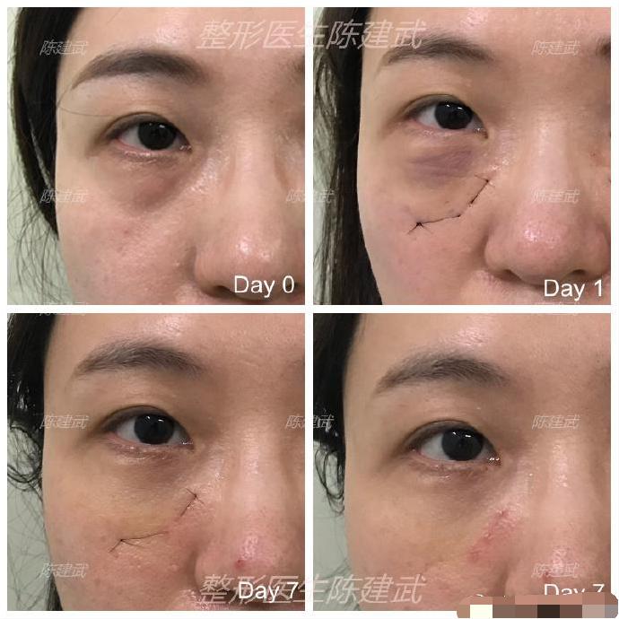 双眼皮眼袋术后真实案例,眼袋手术前视频