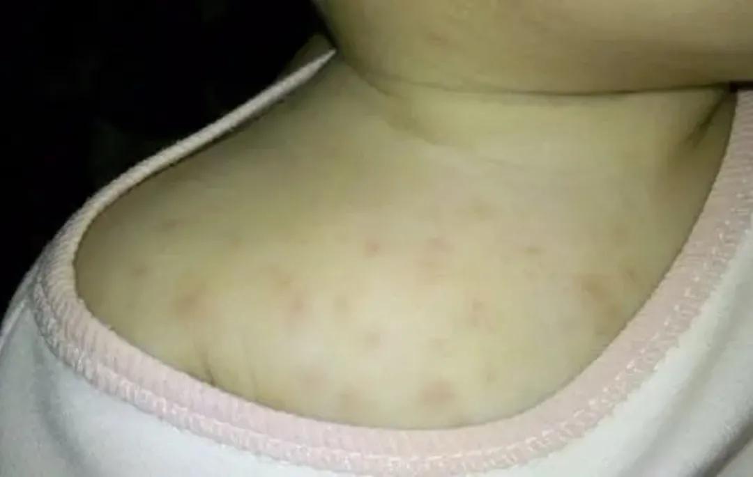 婴儿湿疹擦什么药可以彻底痊愈,儿童嘴部湿疹可以抹芙药师吗