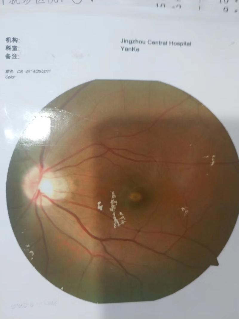 女大学生自购激光笔“洗”文身灼伤眼睛险失明