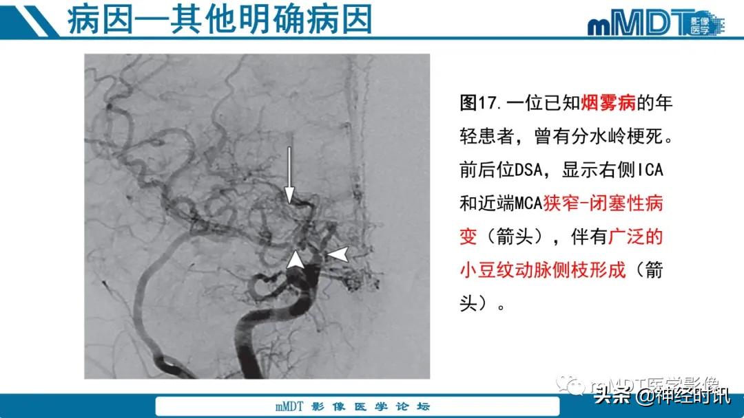 缺血性脑卒中护理课件,缺血性脑卒中讲课ppt