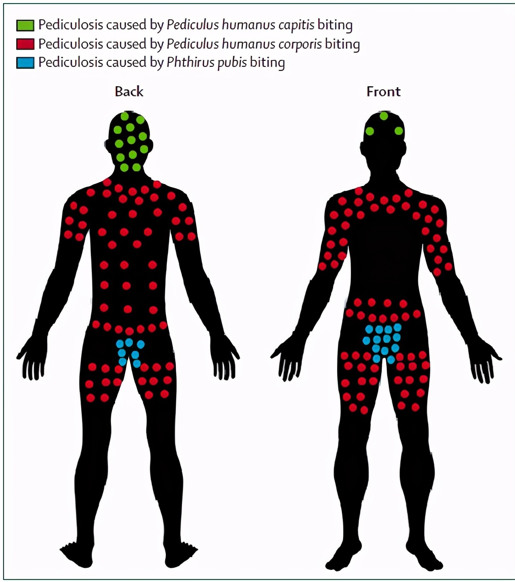 致死率新冠病毒,新冠死亡人数超1918流感