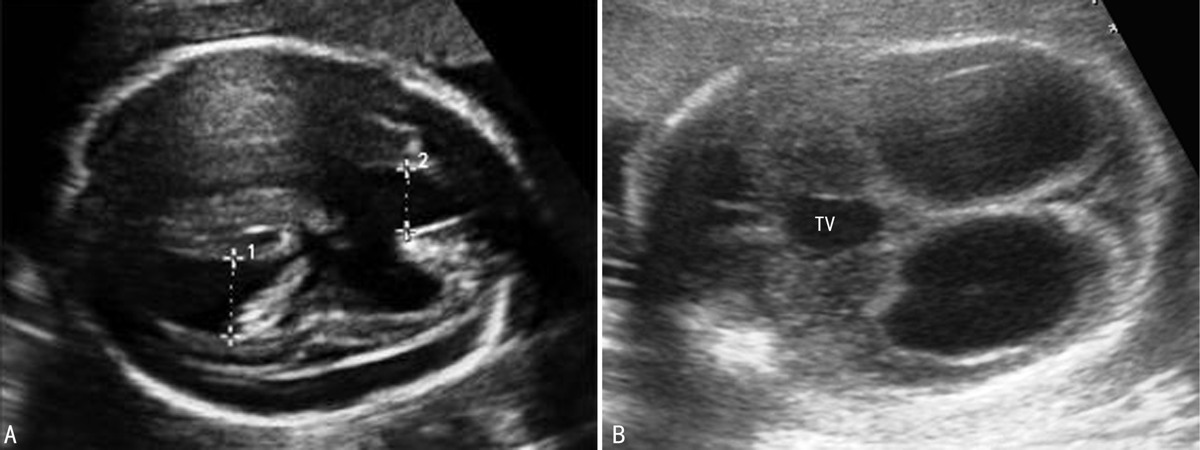 胎儿脑积水的超声图像,胎儿脑积水25m超声图