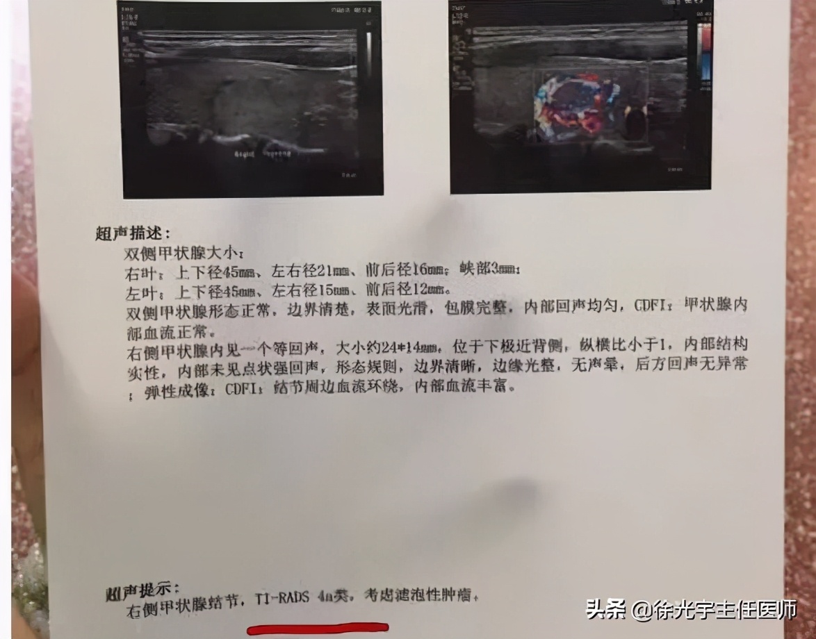 甲状腺结节问题不能被忽视,有甲状腺结节最不应该吃的是什么