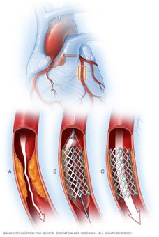 有关心脏病的纪录片,关于心脏病的纪录片