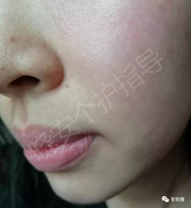 皮炎疹子干燥泛红,秋冬皮肤泛红发烫