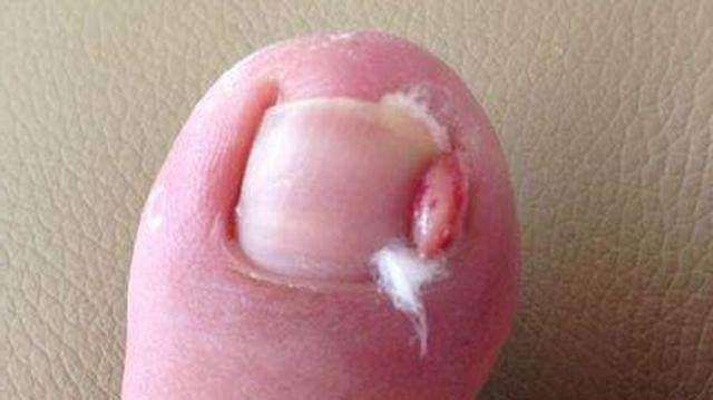 脚趾甲甲沟炎如何自己处理,甲沟炎指甲残留到肉里红肿怎么办