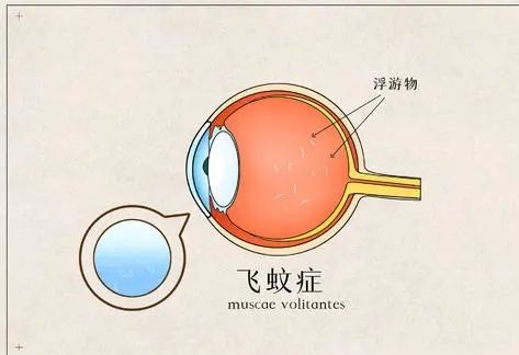眼前有黑点飞蚊症,眼前有飞蚊症是怎么回事