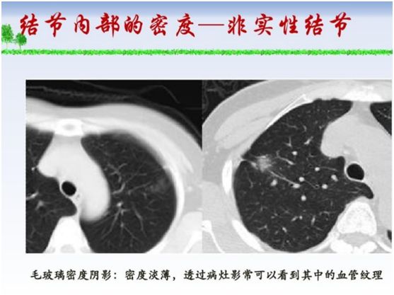 感冒以后做ct发现肺部小结节,乳腺癌术后复查ct发现肺部小结节