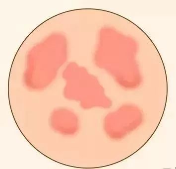 像湿疹样的疹子是什么,大面积小疹子痒怎么解决