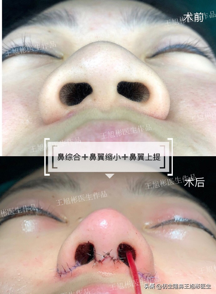 隆鼻鼻头大是失败了吗,大鼻头隆鼻手术案例