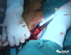 治疗肩锁关节脱位，有最好的方法吗？