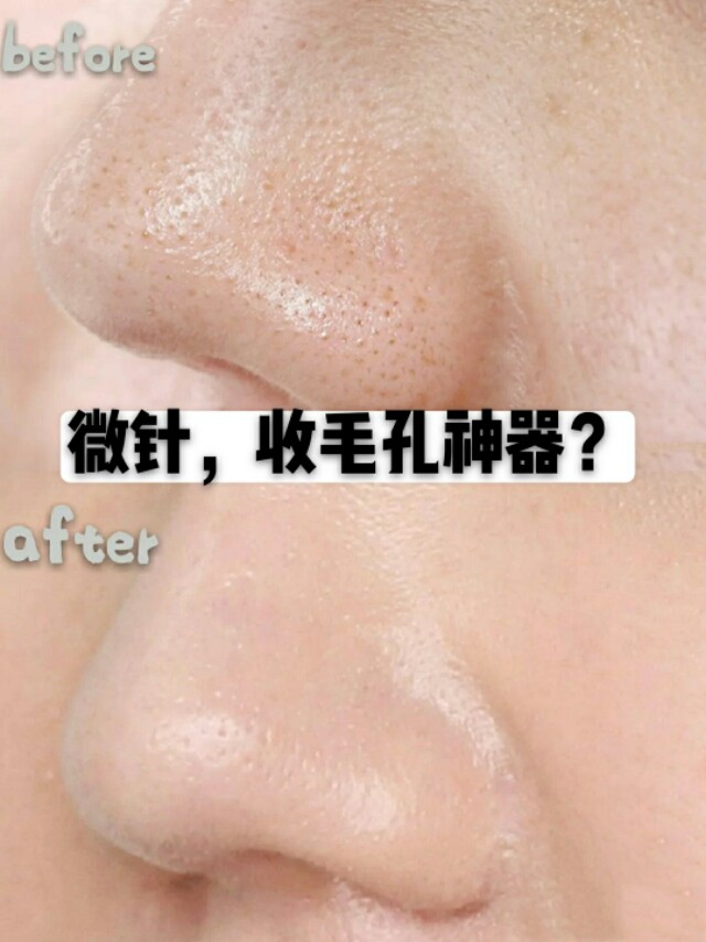 芭贝拉收缩毛孔鼻贴,黑头鼻贴收缩毛孔男