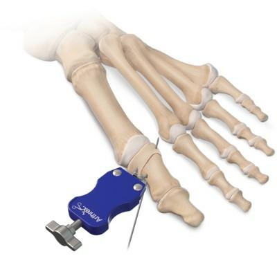 拇外翻大脚趾疼如何在家就能治,大脚拇指痛要警惕