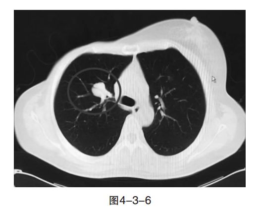肺癌和乳腺癌哪个治愈率高,乳腺癌肺癌双原发治疗方案