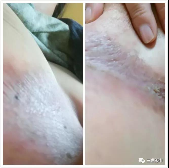 乳房等部位皮肤渗液案